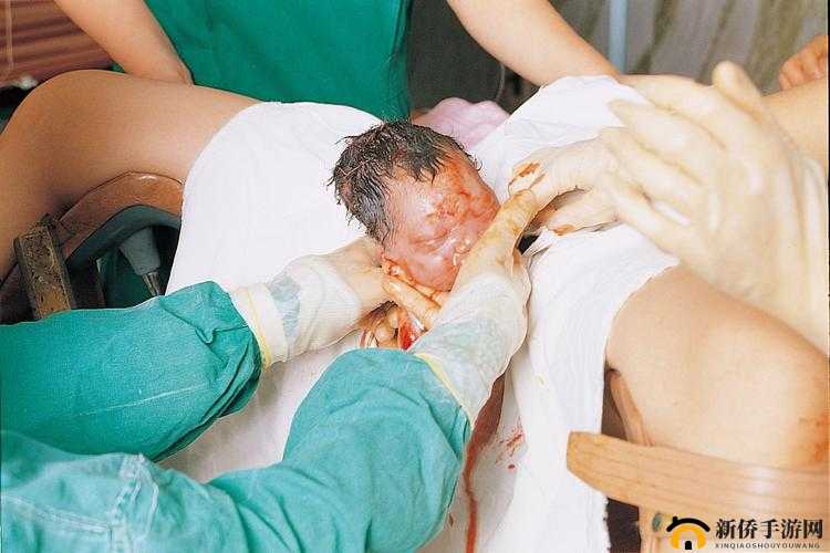 胎头湿漉漉挤出：分娩时刻的震撼场景