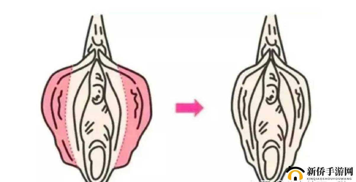 小阴天唇肥大整形有必要吗：探讨与思考