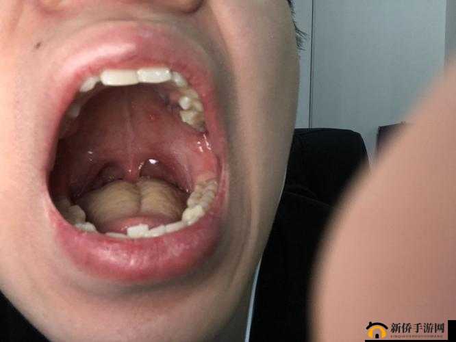舌头舔到硬包疼痛难忍