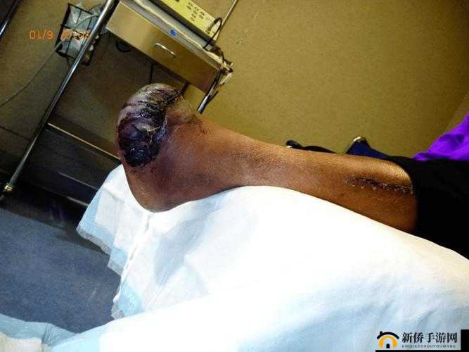 暴血后果之何种不属于所引发的严重影响探讨