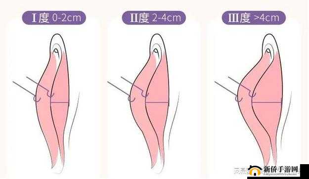 小阴天唇肥大整形有必要吗：是跟风还是科学抉择？