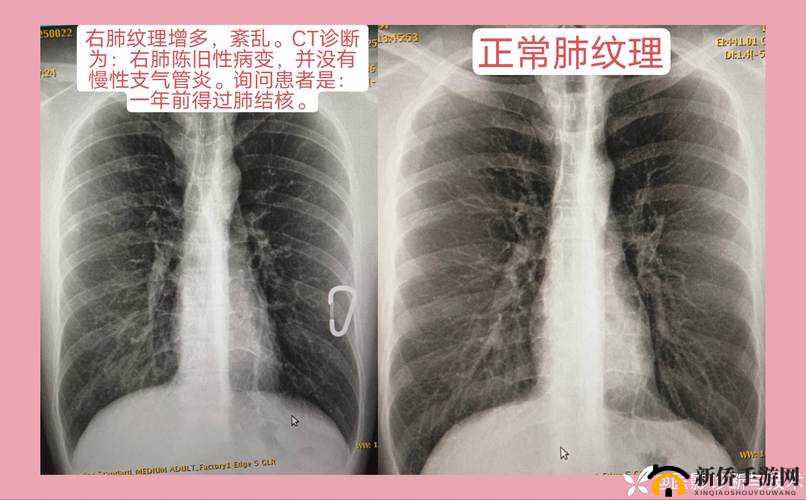 100 胸片曝光率 2024：医疗影像数据的关键指标探讨