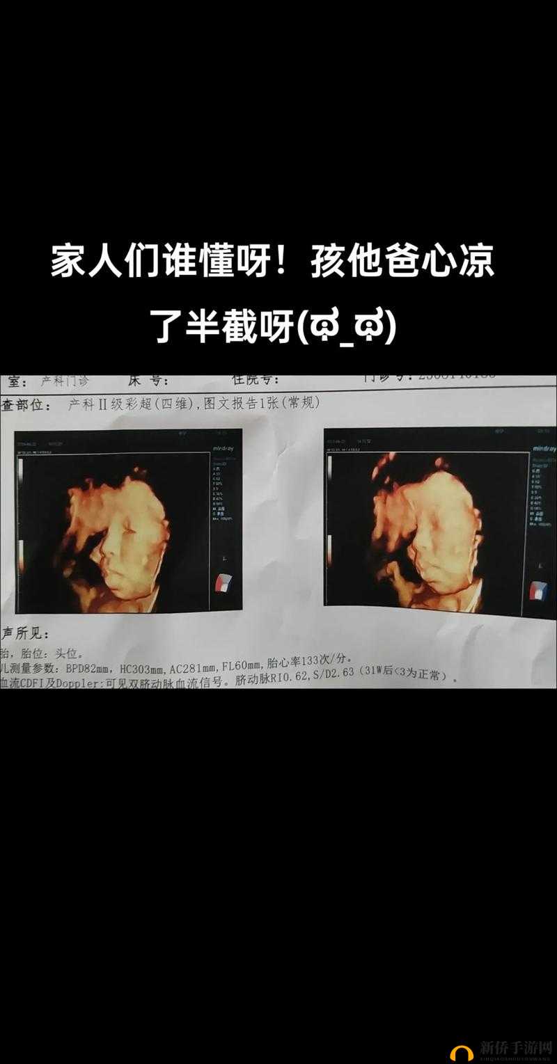 怀孕晚期，医生每次都问做四维，你知道原因吗？